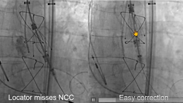 TAVI for aortic regurgitation