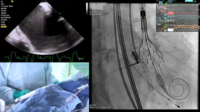 TAVI for pure aortic regurgitation