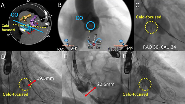 TAVI in bicuspid valves - Pushing the boundaries