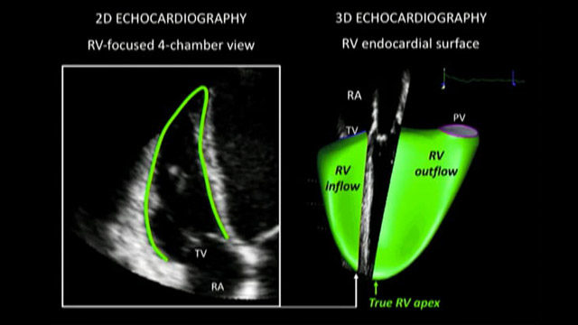 The right ventricle - Key determinant of tricuspid procedural planning and clinical outcomes