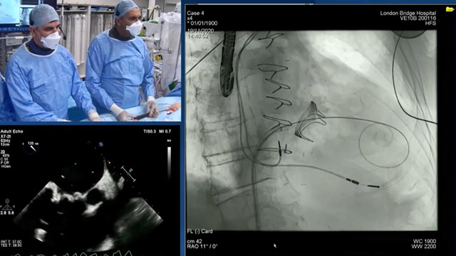 Transcatheter mitral intervention for failed surgical valves and rings - The toolkit