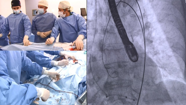 Zero-contrast TAVI while using a novel full-body embolic protection filter