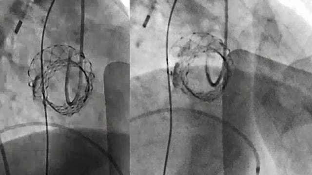 Learn the evidence - Lifetime management of aortic stenosis therapy with self-expandable valve