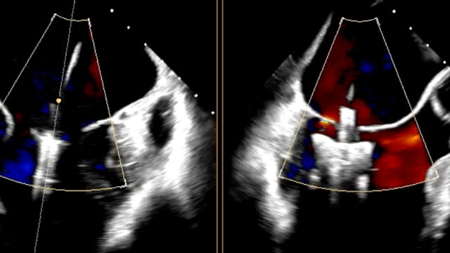 Nightmare in mitral valve interventions: sharing solutions together