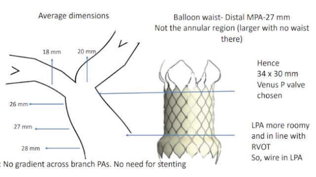 Rapid-fire - Pulmonary and tricuspid valve implantation