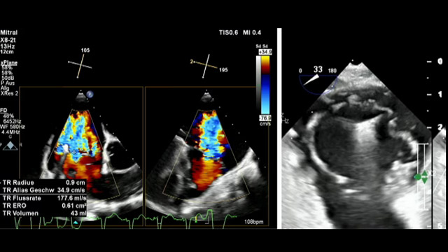 Shaping the future of structural heart disease intervention