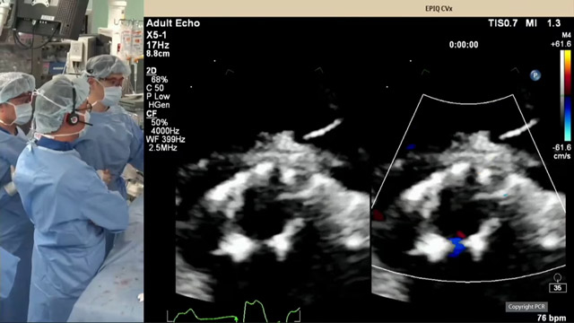 TAVI and future coronary access - LIVE case