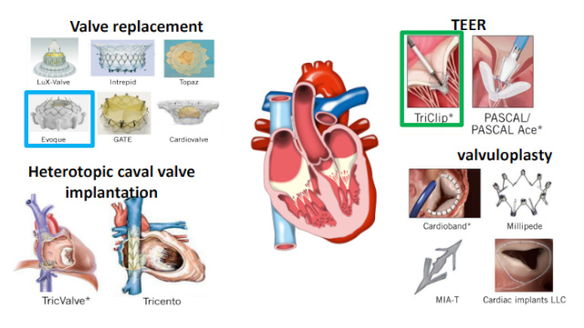 Tricuspid valve interventions