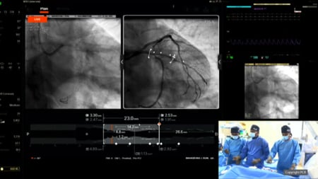 Complex non left main bifurcation - LIVE Case 