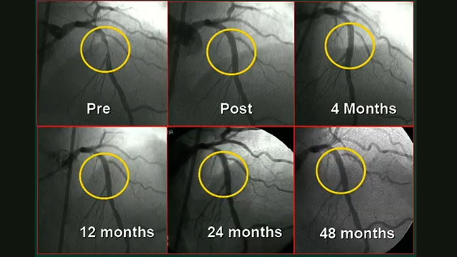 Drug-coated balloons: a PREVAIL-ing gamechanger in complex PCI