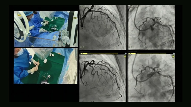 Precision in plaque management: hybrid techniques and IVUS imaging for optimal outcomes