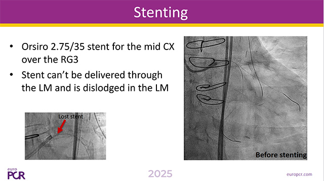 A tale of two branches: lessons from complex bifurcation PCI