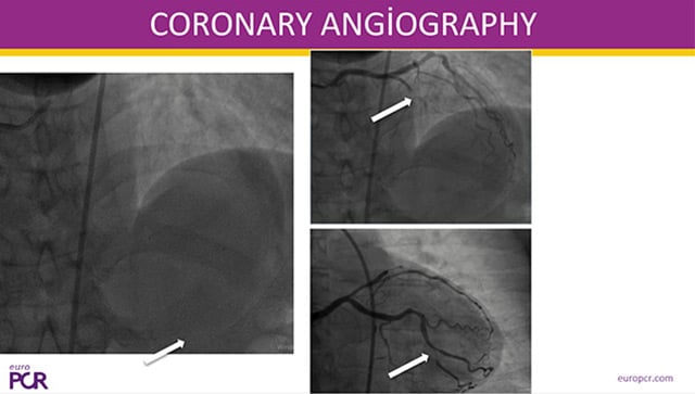 ACS management: when imaging matters