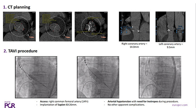 Acute and late coronary complications post-TAVI