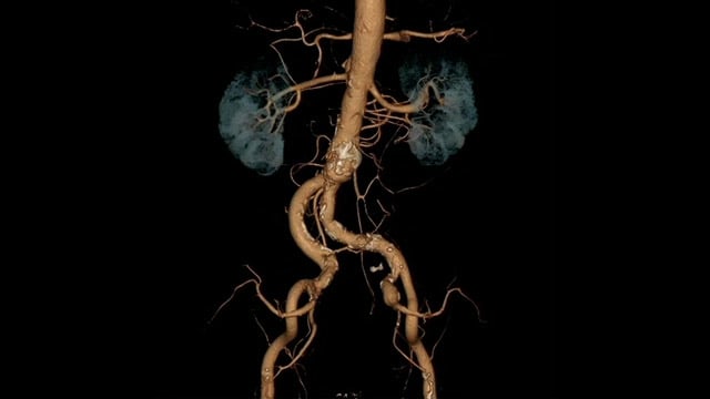 Advancing renal denervation in China: from guidelines to practice