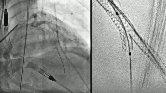 Advancing the standard of care in PCI with Bioadaptor: from simple to complex