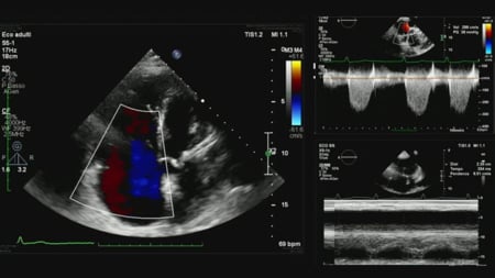 Assessment and management of patients with multivalvular disease involving the tricuspid valve