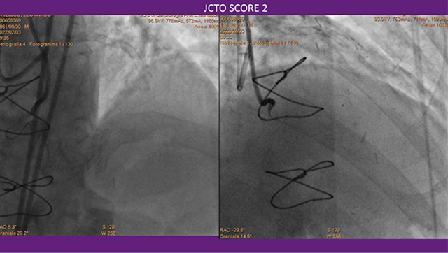 Atherectomy for CTO-PCI