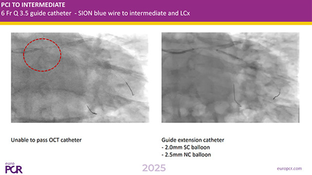 Best companion's case on complications for stable coronary artery disease PCI: episode 1