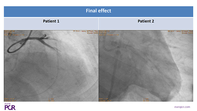 Best companion's case on coronary complications