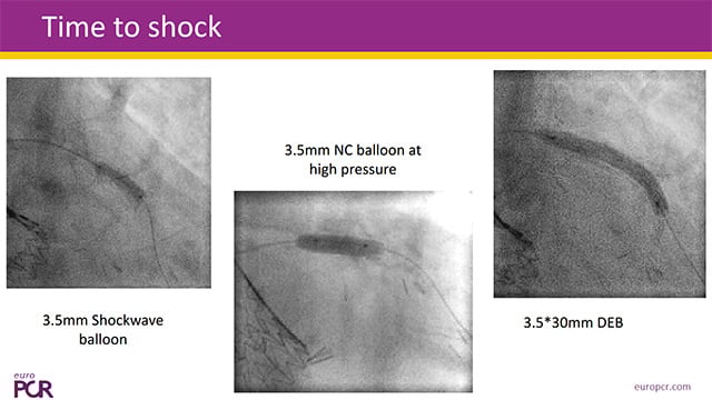 Best companion's case on intravascular lithotripsy