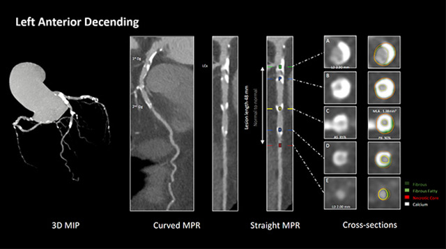 Best companion's cases on imaging for calcified lesions