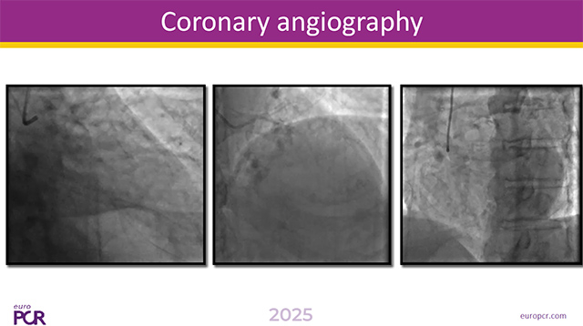 Best companion's cases on orbital atherectomy