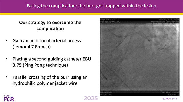 Best companions's case on complications in calcified lesions