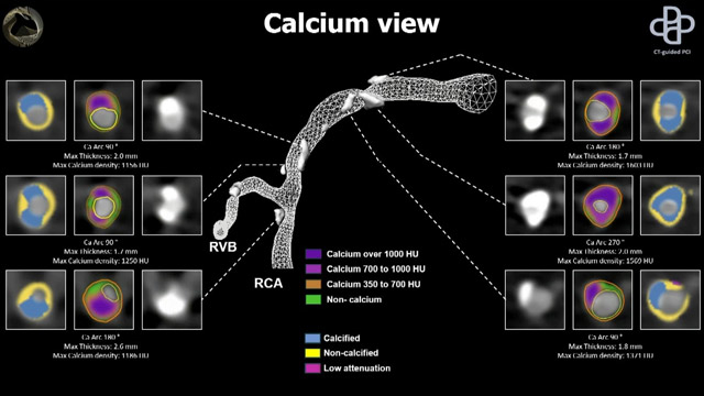 Calcified nodules: a different beast?