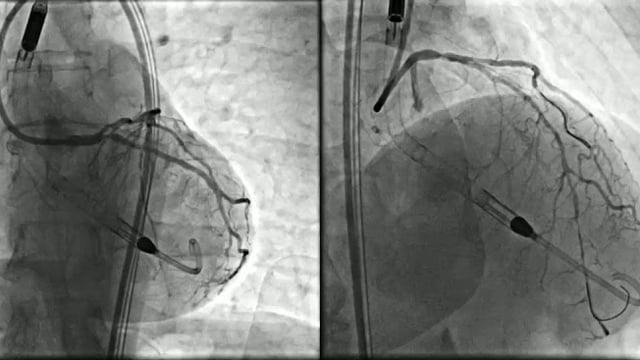 Cardiogenic shock and high-risk interventions with percutaneous mechanical circulatory support: new evidence and insights