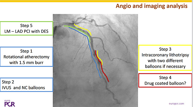 Challenges and complications in coronary interventions