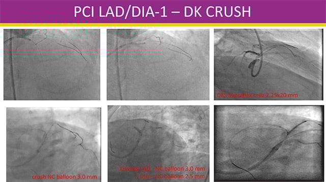 Challenging left main PCI in NSTEMI patients