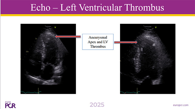 Challenging scenarios in acute coronary syndrome