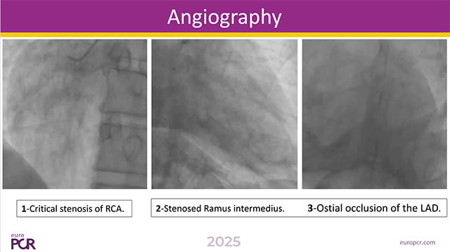 Challenging STEMI cases: unwanted situations