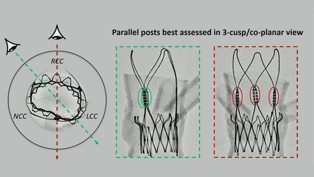 Clinical implications of TAVI and cerebral embolic protection - Current challenges and future considerations