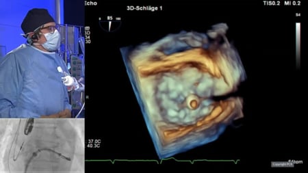 Combined LAA closure and transcatheter mitral valve repair - LIVE Case
