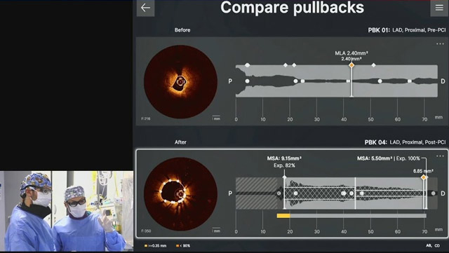 Complex calcified lesions: combination of intravascular imaging and orbital atherectomy for optimal outcomes