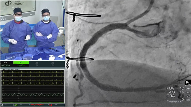 Complex PCI in calcific coronary artery disease - LIVE Case