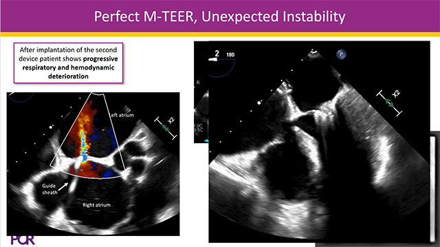 Complication management during mitral TEER procedures