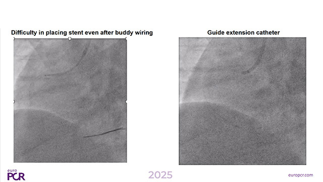 Complications in STEMI : dissections and more
