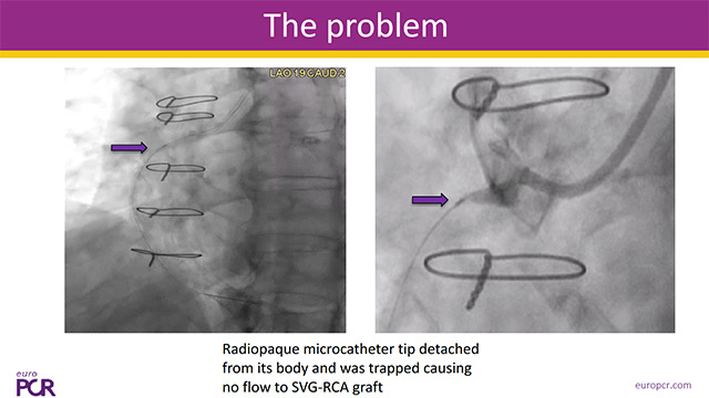 Coronary complications: sharing the unusual ones