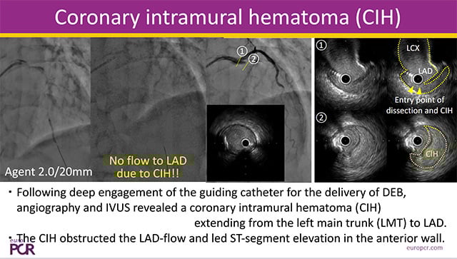 Coronary dissection : when imaging makes the difference