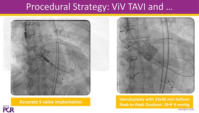 Coronary protection during native and valve-in-valve TAVI
