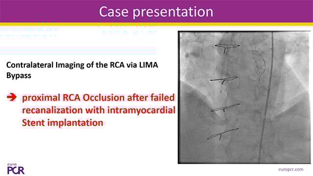 CTO after CABG: complex but feasible