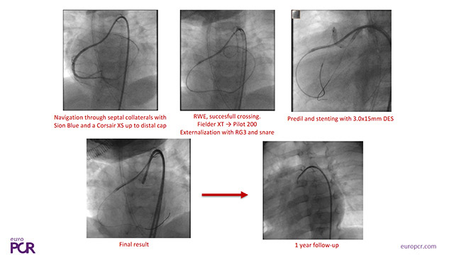 CTO in special clinical scenarios