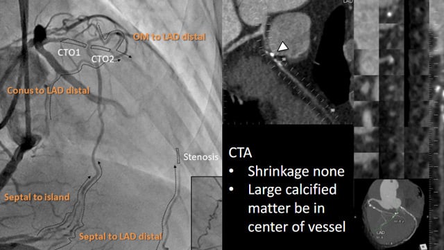 CTO PCI with Asian flavour