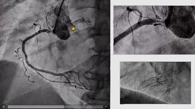 Current DCB practice: from lesion preparation to follow-up