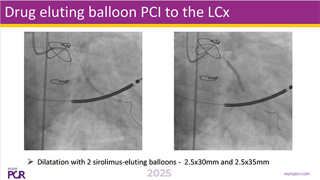 DCB in de novo lesions: new valid option?