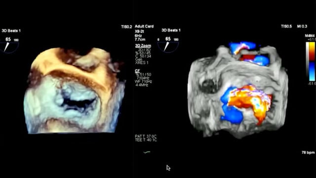 Decompensated heart failure: indication and management of mechanical circulatory support