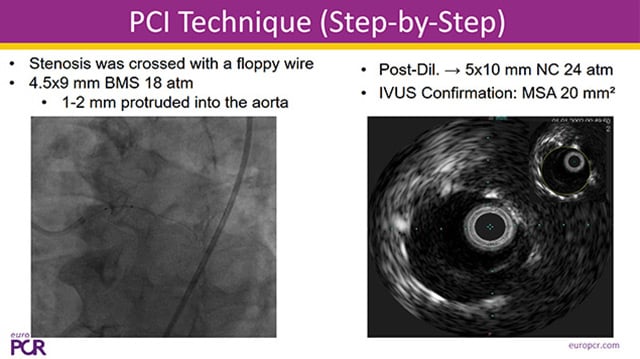 Difficult decision-making in left main revascularisation